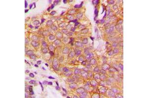 Immunohistochemical analysis of GSK3 beta (pS9) staining in human breast cancer formalin fixed paraffin embedded tissue section. (GSK3 beta anticorps  (N-Term, pSer9))