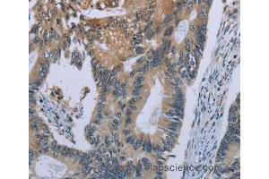 Immunohistochemistry of Human colon cancer using CEBPD Polyclonal Antibody at dilution of 1:40 (CEBPD anticorps)