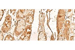 Immunohistochemistry of paraffin-embedded Human liver cancer tissue using WDR33 Polyclonal Antibody at dilution of 1:65(x200) (WDR33 anticorps)