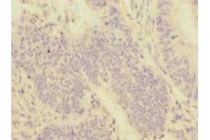 Immunohistochemistry of paraffin-embedded human colon cancer using ABIN7159959 at dilution of 1:100 (PMPCA anticorps  (AA 456-525))