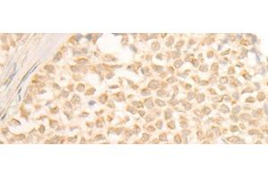 Immunohistochemistry of paraffin-embedded Human ovarian cancer tissue using CYP4X1 Polyclonal Antibody at dilution of 1:40(x200) (CYP4X1 anticorps)