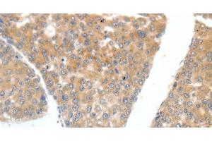 Immunohistochemistry of paraffin-embedded Human liver cancer tissue using FSHR Polyclonal Antibody at dilution 1:70 (FSHR anticorps)