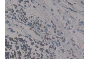 Detection of MCP4 in Human Stomach cancer Tissue using Polyclonal Antibody to Monocyte Chemotactic Protein 4 (MCP4)