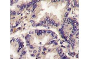 IHC analysis of FFPE human lung carcinoma tissue stained with VEGFC antibody