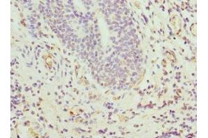 Immunohistochemistry of paraffin-embedded human bladder cancer using ABIN7144067 at dilution of 1:100