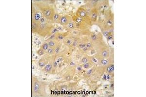 Formalin-fixed and paraffin-embedded human hepatocarcinoma tissue reacted with L antibody (N-term) (ABIN391461 and ABIN2841436) , which was peroxidase-conjugated to the secondary antibody, followed by DAB staining.