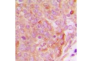 Immunohistochemical analysis of PP15 staining in human breast cancer formalin fixed paraffin embedded tissue section. (NUTF2 anticorps)