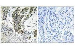 Immunohistochemistry analysis of paraffin-embedded human lung carcinoma tissue using RREB1 antibody. (RREB1 anticorps)