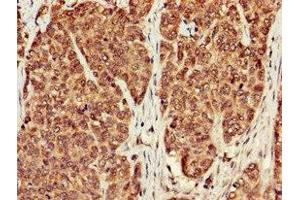 Immunohistochemistry of paraffin-embedded human ovarian cancer using ABIN7169308 at dilution of 1:100