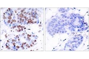 Immunohistochemistry analysis of paraffin-embedded human breast carcinoma tissue, using NF-kappaB p65 (Ab-276) Antibody. (NF-kB p65 anticorps  (AA 249-298))