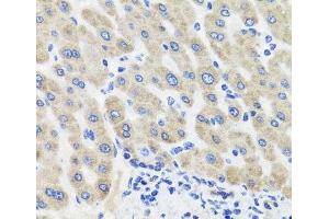 Immunohistochemistry of paraffin-embedded Human liver damage using HSD11B2 Polyclonal Antibody at dilution of 1:100 (40x lens). (HSD11B2 anticorps)