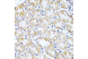 Immunohistochemistry of paraffin-embedded human stomach cancer using ANKRD52 antibody at dilution of 1:100 (40x lens). (ANKRD52 anticorps)