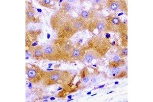 Immunohistochemical analysis of SCYL1 staining in human liver cancer formalin fixed paraffin embedded tissue section. (SCYL1 anticorps)