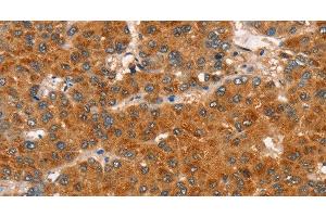 Immunohistochemistry of paraffin-embedded Human liver cancer tissue using RASA3 Polyclonal Antibody at dilution 1:35 (RASA3 anticorps)