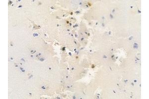 ABIN6260848 and ABIN6278168 at 1/100 staining human glioblastoma by IHC-P.