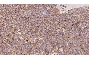ABIN6273183 at 1/100 staining Human lymph cancer tissue by IHC-P. (UQCRC2 anticorps  (Internal Region))