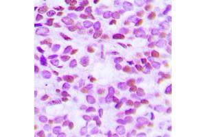 Immunohistochemical analysis of Histone H2B (AcK15) staining in human breast cancer formalin fixed paraffin embedded tissue section.