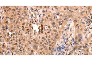 Immunohistochemistry of paraffin-embedded Human lung cancer using ACO2 Polyclonal Antibody at dilution of 1:30