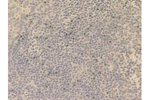 ABIN6258358 and ABIN6274562 at 1/100 staining human tongue carcinoma by IHC-P. (YWHAB anticorps  (C-Term))