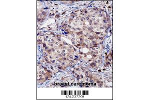 RNF144A Antibody immunohistochemistry analysis in formalin fixed and paraffin embedded human breast carcinoma followed by peroxidase conjugation of the secondary antibody and DAB staining.