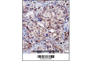 RNF144A Antibody immunohistochemistry analysis in formalin fixed and paraffin embedded human breast carcinoma followed by peroxidase conjugation of the secondary antibody and DAB staining. (RNF144A anticorps  (AA 156-184))