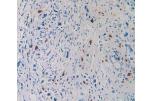 IHC-P analysis of Human Stomach Cancer Tissue, with DAB staining. (TPSAB1 anticorps  (AA 161-262))