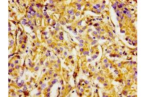 Immunohistochemistry of paraffin-embedded human liver cancer using ABIN7156425 at dilution of 1:100 (Integrin alpha 1 anticorps  (AA 242-524))