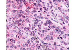 Anti-MRGPRX4 / MRGX4 antibody IHC of human Lung, Non-Small Cell Carcinoma. (MRGPRX4 anticorps  (N-Term))
