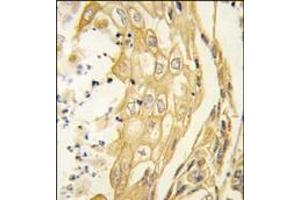 Formalin-fixed and paraffin-embedded human lung carcinoma tissue reacted with the EphB4 antibody, which was peroxidase-conjugated to the secondary antibody, followed by DAB staining.