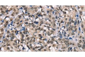 Immunohistochemistry of paraffin-embedded Human esophagus cancer using NSMCE3 Polyclonal Antibody at dilution of 1:40