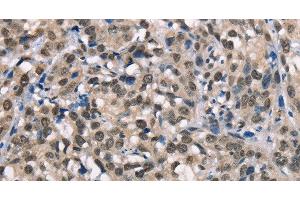 Immunohistochemistry of paraffin-embedded Human esophagus cancer using NSMCE3 Polyclonal Antibody at dilution of 1:40 (Necdin-Like 2 anticorps)