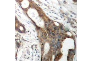 Immunohistochemical analysis of ASCT1 staining in human ovarian cancer formalin fixed paraffin embedded tissue section. (SLC1A4 anticorps)