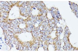 Immunohistochemistry of paraffin-embedded Human colon carcinoma using ACAT2 Polyclonal Antibody at dilution of 1:100 (40x lens). (ACAT2 anticorps)