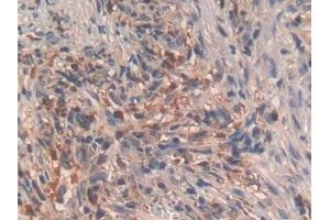 Detection of GHRH in Human Lung cancer Tissue using Polyclonal Antibody to Growth Hormone Releasing Hormone (GHRH) (GHRH anticorps  (AA 19-108))