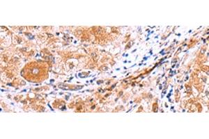 Immunohistochemistry of paraffin-embedded Human liver cancer tissue using IRGC Polyclonal Antibody at dilution of 1:30(x200) (IRGC anticorps)