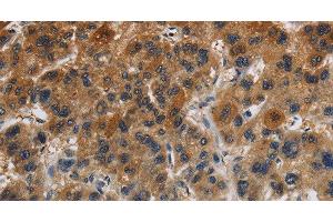 Immunohistochemistry of paraffin-embedded Human liver cancer tissue using Claudin 8 Polyclonal Antibody at dilution 1:50