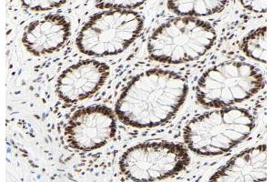ABIN6267330 at 1/200 staining human colon carcinoma tissue sections by IHC-P.