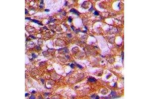 Immunohistochemical analysis of RPS12 staining in human prostate cancer formalin fixed paraffin embedded tissue section.