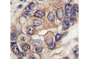 IHC analysis of FFPE human hepatocarcinoma tissue stained with PDGFR antibody (PDGFRA anticorps  (AA 698-727))