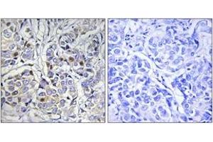 Immunohistochemistry analysis of paraffin-embedded human breast carcinoma tissue, using Centromeric Protein A (Ab-7) Antibody. (CENPA anticorps  (AA 1-50))