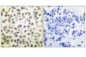 Immunohistochemical analysis of paraffin-embedded human colon carcinoma tissue using STAT5B (Ab-731) antibody.