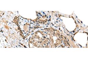 Immunohistochemistry of paraffin-embedded Human thyroid cancer tissue using TPPP Polyclonal Antibody at dilution of 1:25(x200) (Tppp anticorps)