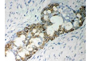 Anti-Caspase-7 Picoband antibody, (ABIN3042355),IHC(P)IHC(P): Human Mammary Cancer Tissue