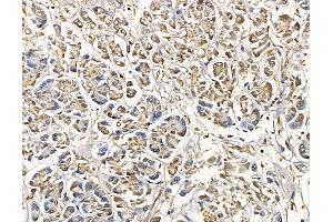 ABIN6265341 and ABIN6279794 at 1/100 staining human pancreatic cancer by IHC-P.