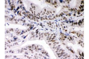 Anti- DAXX Picoband antibody,IHC(P) IHC(P): Human Intestinal Cancer Tissue (DAXX anticorps  (AA 56-345))