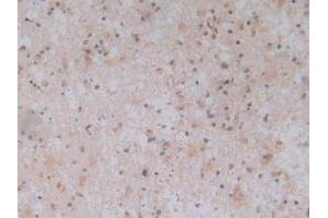 IHC-P analysis of Human Glioma Tissue, with DAB staining. (TLR9 anticorps  (AA 28-362))