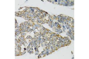Immunohistochemistry of paraffin-embedded human esophageal cancer using PI3 antibody (ABIN6293676) at dilution of 1:100 (40x lens). (PI3 anticorps)