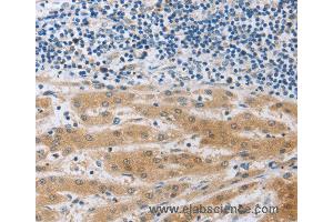 Immunohistochemistry of Human liver cancer using MUC20 Polyclonal Antibody at dilution of 1:40