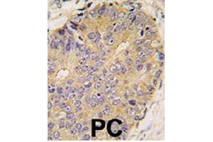Formalin-fixed and paraffin-embedded human prostate carcinoma tissue reacted with BMP15 polyclonal antibody  , which was peroxidase-conjugated to the secondary antibody, followed by DAB staining. (BMP15 anticorps  (Internal Region))