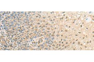 Immunohistochemistry of paraffin-embedded Human tonsil tissue using PPCDC Polyclonal Antibody at dilution of 1:55(x200)